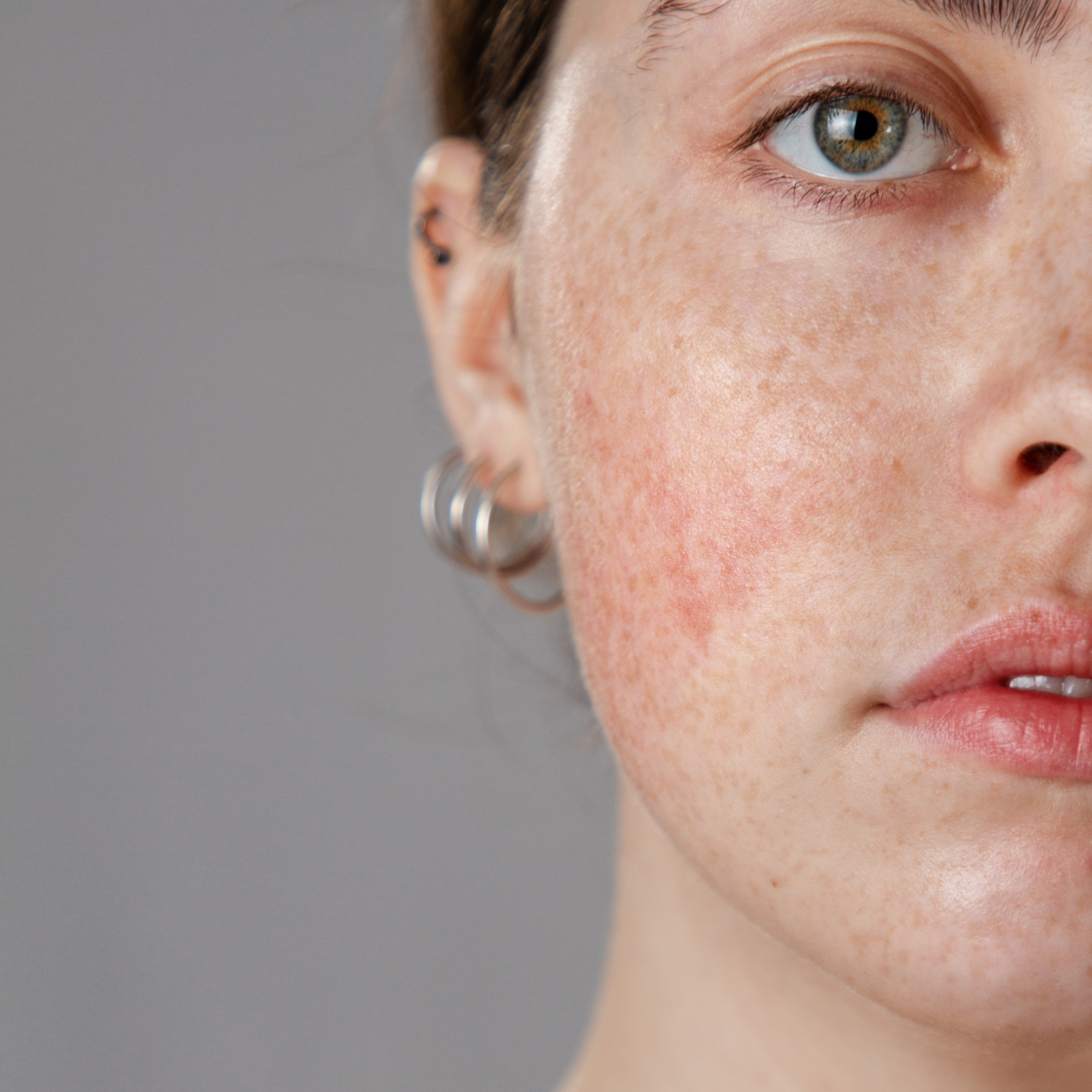 Rosacea im Gesicht: Symptome erkennen und richtig behandeln