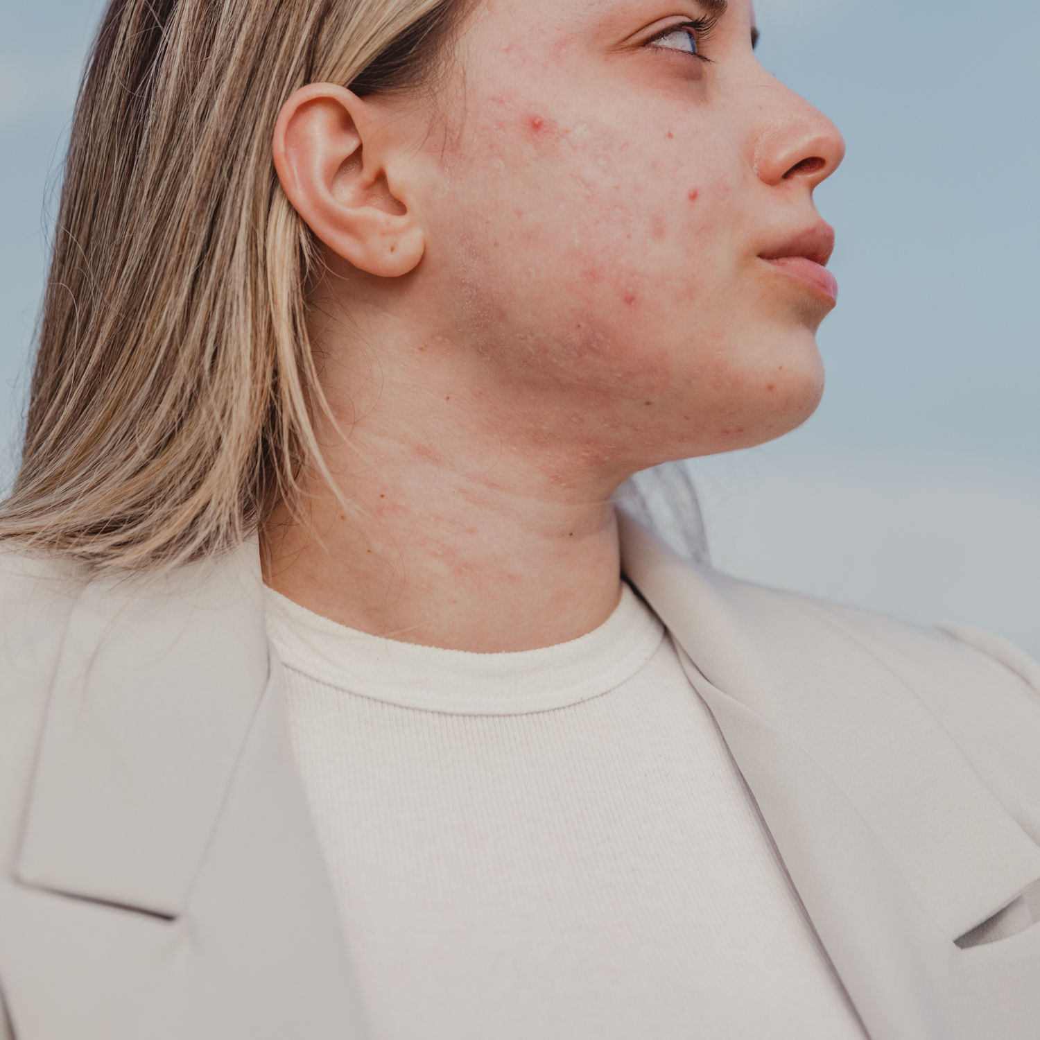 Schluss mit hormonell bedingter Akne - So beruhigst du deine Haut nachhaltig